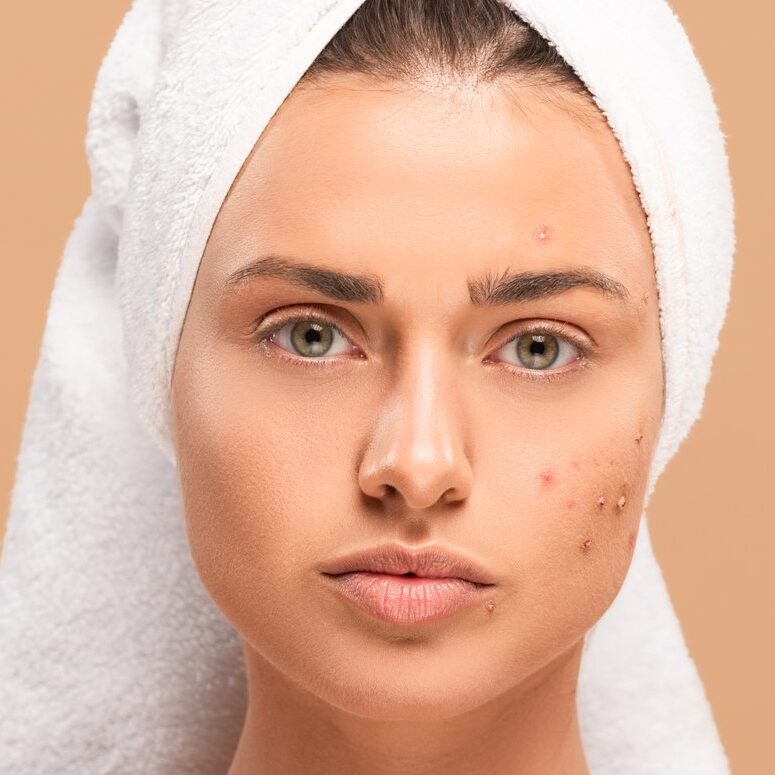 Anti-acne Facial
